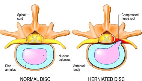 Intervertebral Discs Structure Function And Disorders Spine Info