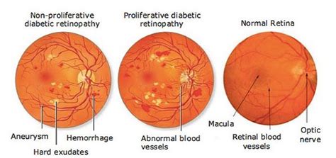 Diabetic Retinopathy Eye And Retina Specialists