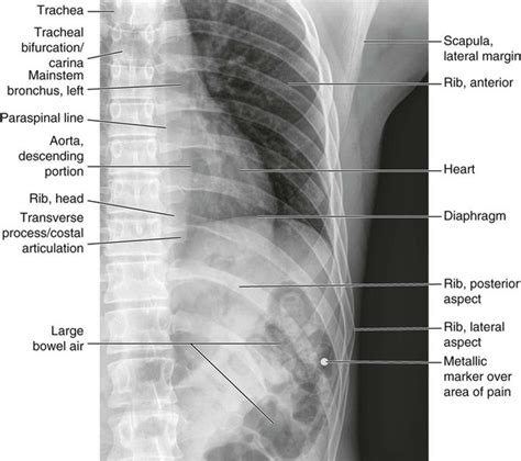 Each pair articulates with a different thoracic vertebra on the posterior side of the body. Normal Anatomy | Radiology Key