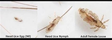How To Get Rid Of Dead Lice Eggs In Your Hair Astar Tutorial
