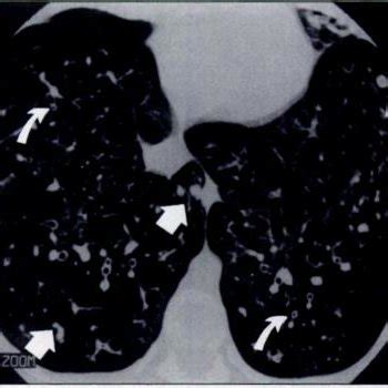 Year Old Girl With Cystic Fibrosis A Initial Ct Scan Obtained At