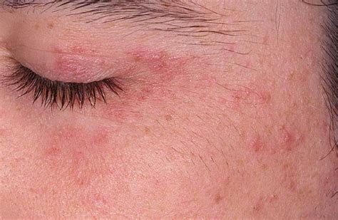 Perioral Dermatitis Eyes