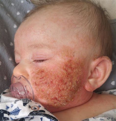 Baby Lives In Agony As Skin Burns Peels Off And Scabs Over Daily