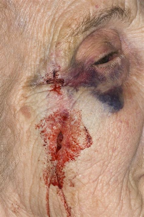 Laceration to the face - Stock Image - C007/2741 - Science Photo Library