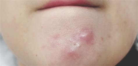 Acne Treatments Cystic Acne Laser Therapy