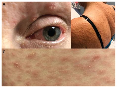 Papulosquamous Eruption With Ocular Symptoms Caused By Syphilis Cmaj