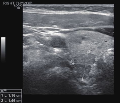 Right Thyroid Nodule Ultrasound Demonstrating Microcalcifications