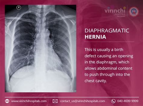 Diaphragmatic Hernia Definition Causes Symptoms Complications And My