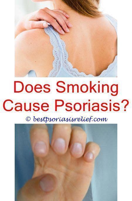 Everything You Need To Know About Psoriasis Severe Psoriasis
