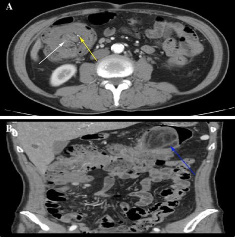 Transverse And Coronary Contrast Enhanced Computed Tomography Cect Of