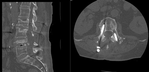 Pedicle Subtraction Osteotomy For Treatment Of Sagittal Plane Deformity