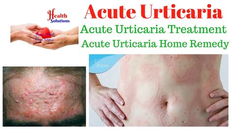 Acute Urticaria Acute Urticaria Treatment Acute Urticaria Home