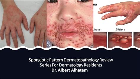Dermatopathology Lesson 1 Spongiotic Dermatitis Tissue Reaction