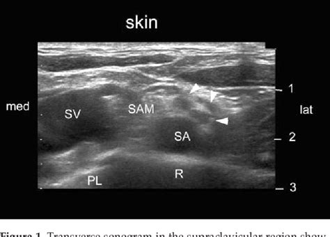 Ultrasound Guided Supraclavicular Brachial Plexus Block Semantic Scholar