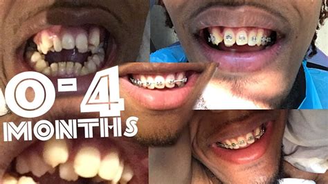 0 4 Months Braces Time Lapse Most Incredible Transformation Ever