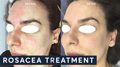 One Medium 1 Ipl Treatment Sun Spots Veins Rosacea Skin