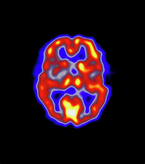Coloured Pet Scan Of The Brain Of A Stroke Patient Photograph By Dept