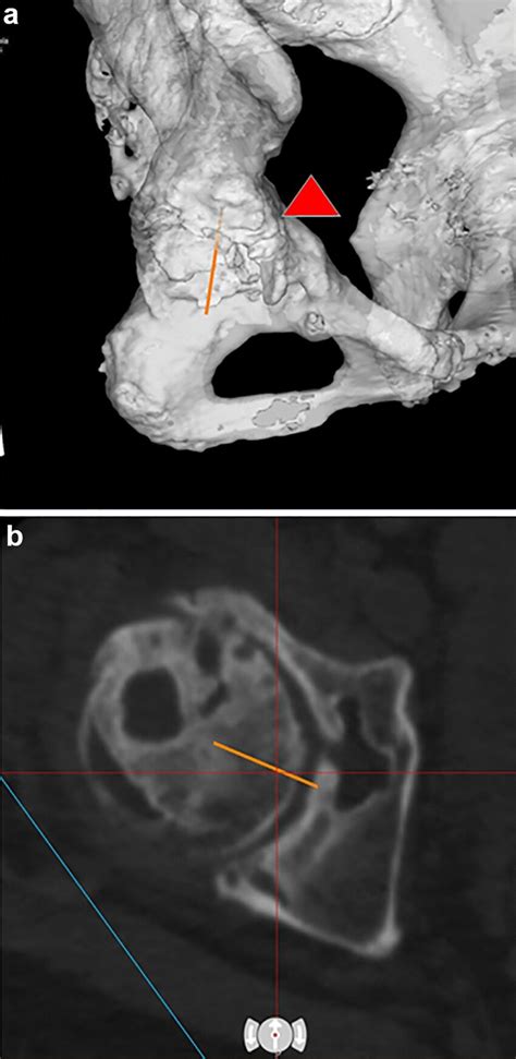 Pre Operative Computed Tomography For Tha After Rao A Download