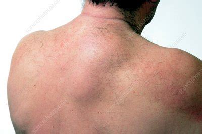 Large Lipoma On The Back Stock Image C013 9723 Science Photo Library
