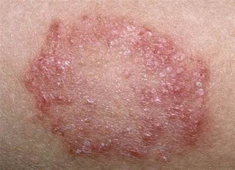 Skin Disease Or Eczema Neczema—also Known As Atopic Dermatitis This