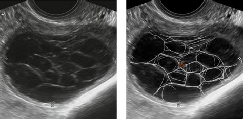 Ovarian Cyst Types Ultrasound