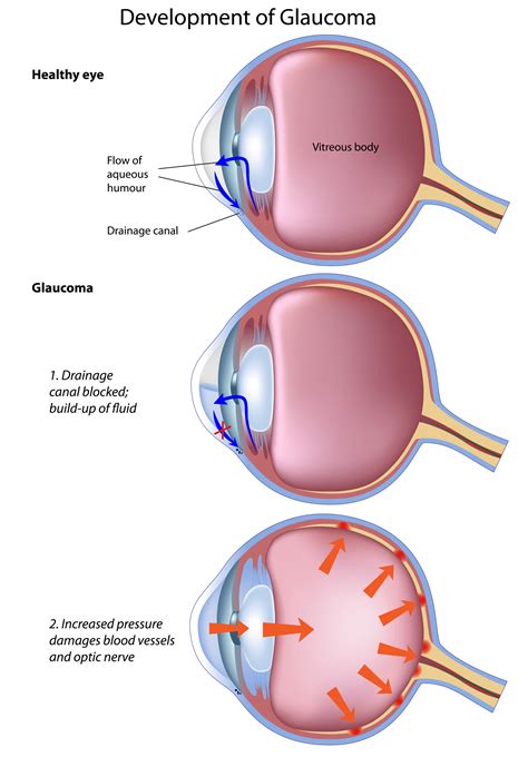 The symptoms of acute glaucoma appear suddenly and include: Glaucoma | Krieger Eye