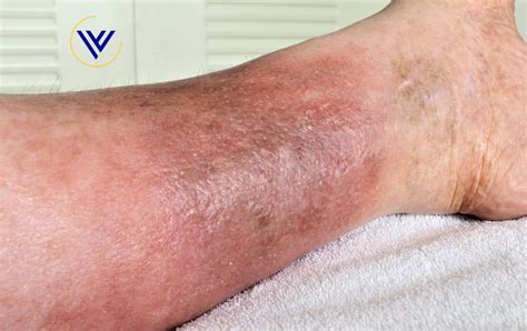 Can Varicose Veins Cause Skin Discoloration Center For Varicose Veins