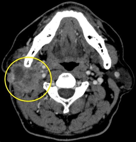 Ct Scan Demonstrates A Mass Lesion Located In The Right Parotid Gland