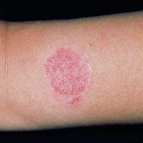 How Long Does Contact Dermatitis Last Nickel Allergy Symptoms And