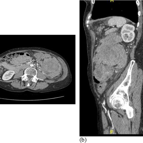 Ct Scans With Iv Contrast A Shows The Axial View Revealing A Large