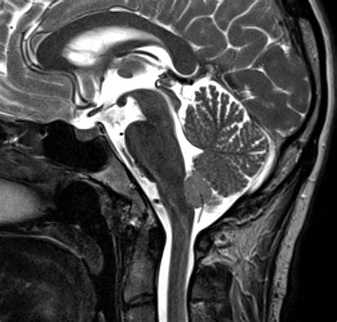 Subependymoma Eurorad