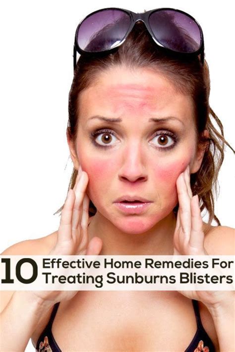 how to get rid of a sunburn overnight Fast Home Remedies ...