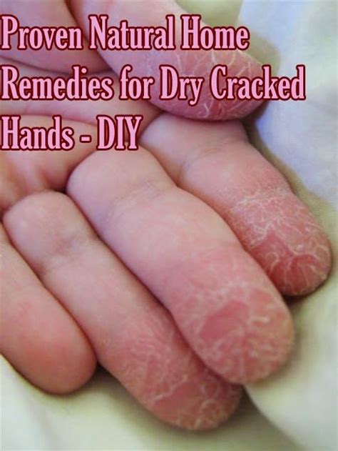 Proven Natural Home Remedies For Dry Cracked Hands Diy Natural Home