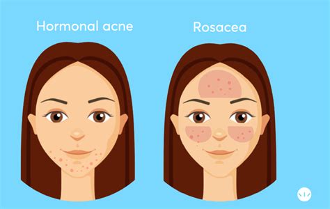 Best Treatments For Adult Acne According To Dermatologists Mdacne