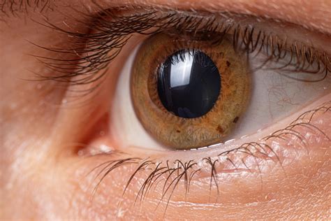 Macro Eye Photo Keratoconus Eye Disease Thinning Of The Cornea In