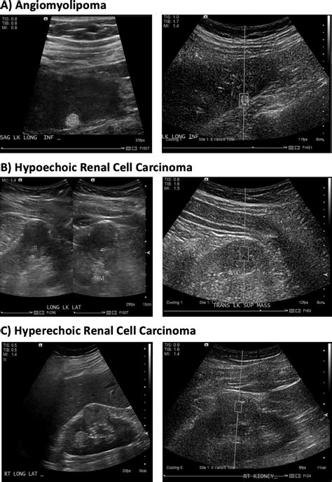 Point Shear Wave Elastography Using Machine Learning To Differentiate Renal Cell Carcinoma And