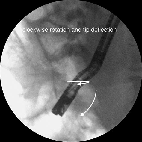Common Bile Duct Intussusception During Ercp For Stone Removal Videogie