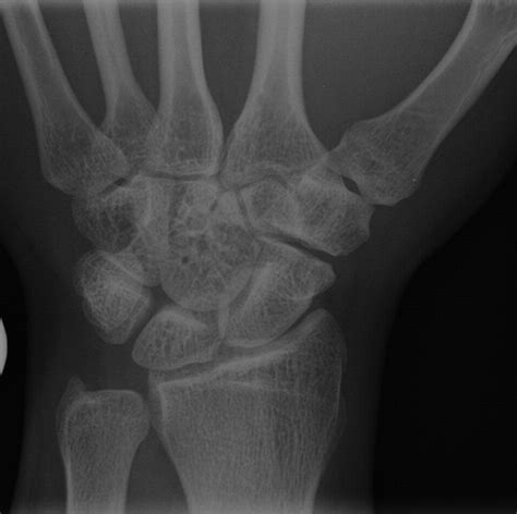 Unilateral Isolated Coalition Of The Scaphoid And