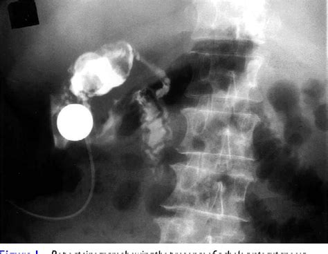 Figure From Case Report Spontaneous Cholecystocutaneous Fistula