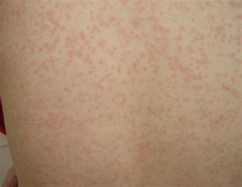 麻疹和急疹图片对比麻疹是什么样图片大山谷图库