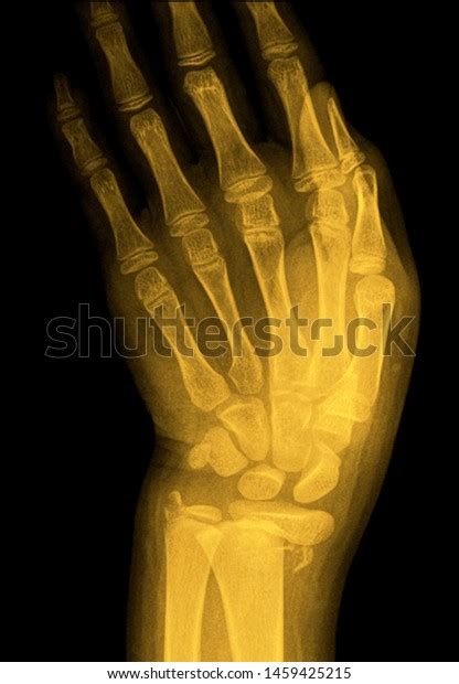 Wrist X Ray Anatomy Radiology Radiographic Stock Photo 1459425215