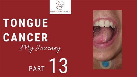 Photos Of Tongue Cancer 3 Weeks Post Surgery My Journey Part 13 Of