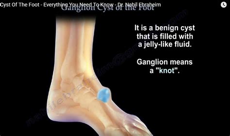 Ganglion cysts are a common condition that can develop on the top or bottom of the foot.they are not harmful or cancerous, although they may cause discomfort. Ganglion Cyst of the Foot — OrthopaedicPrinciples.com