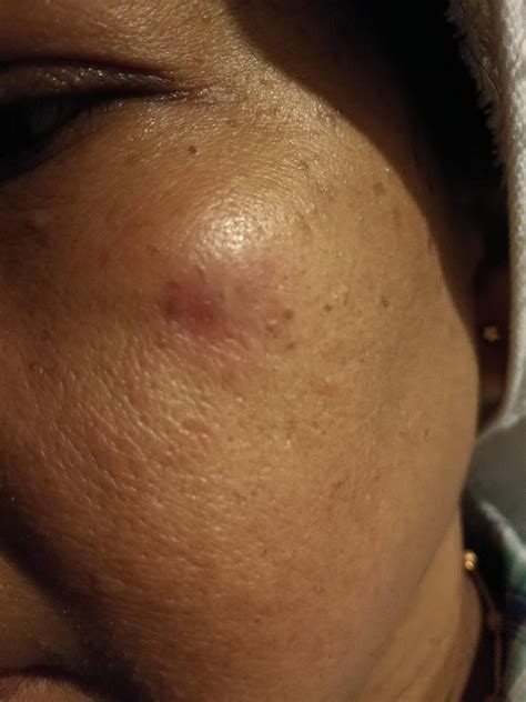 [skin concerns] my mum had a tiny bump under her skin for a couple of months now she never