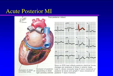 Ppt Acute Myocardial Infarction Powerpoint Presentation Free