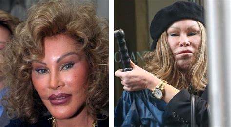 10 Worst Celebrity Plastic Surgery Before And After Photos