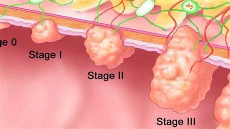 Stage 4 bowel (colon and rectal) cancer means the cancer has spread to other parts of the body, such as the liver or lungs. Colon Cancer Survival Rate | IYTmed.com