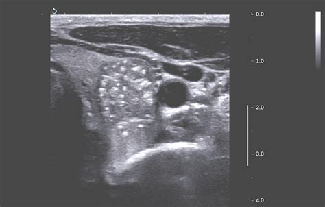 Vietnamese Medic Ultrasound Case Thyroid Cancer Dr Phan Thanh