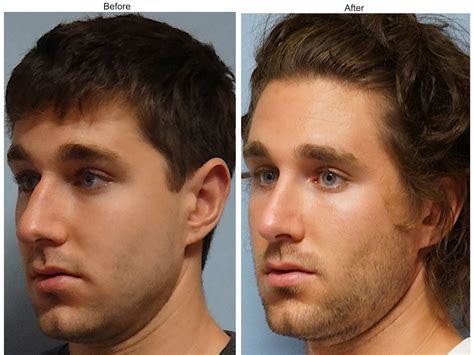 Facial Plastic Surgery Male Rhinoplasty Cosmetic Rhinoplasty Nose