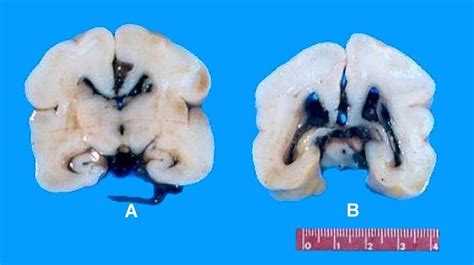 Intraventricular Hemorrhage Coronal Sections Of The Brain Of A